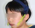 ヘッドギア（子どもの上顎前突の治療）