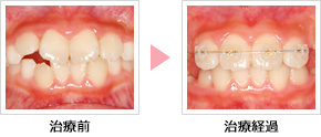 子どもの前歯４本の矯正治療開始前後