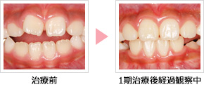子どもの前歯部開咬の矯正治療開始前後