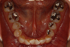 叢生抜歯症例初診時下顎咬合面