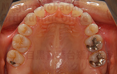 叢生抜歯症例矯正治療中右側面