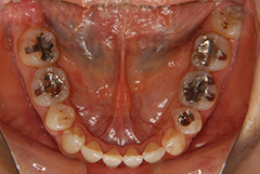 叢生抜歯症例矯正治療中左側面