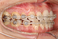 叢生抜歯症例矯正治療中右側面