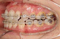 叢生抜歯症例矯正治療中左側面