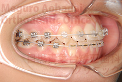 叢生非抜歯症例矯正治療中右側面