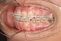 叢生非抜歯症例矯正治療中左側面