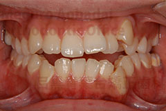 叢生抜歯舌側矯正症例初診時正面