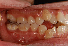 叢生抜歯舌側矯正症例右側面