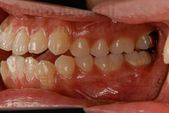 叢生抜歯舌側矯正症例左側面