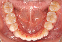 叢生抜歯症例矯正治療後下顎咬合面