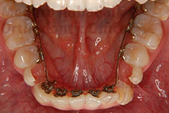 叢生抜歯症例矯正治療中下顎咬合面