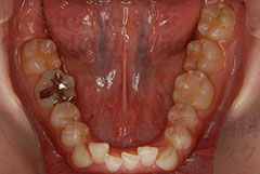 叢生非抜歯舌側矯正症例下顎咬合面
