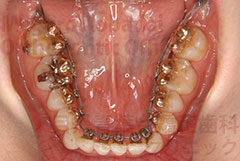叢生非抜歯症例矯正治療中下顎咬合面
