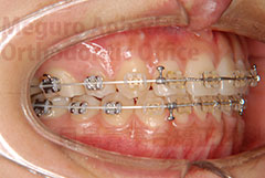 顎変形症外科症例矯正治療中右側面