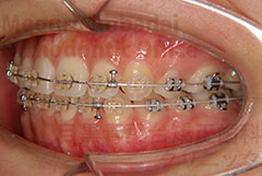 顎変形症外科症例矯正治療中左側面