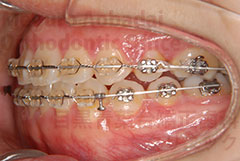 顎変形症外科症例矯正治療中左側面
